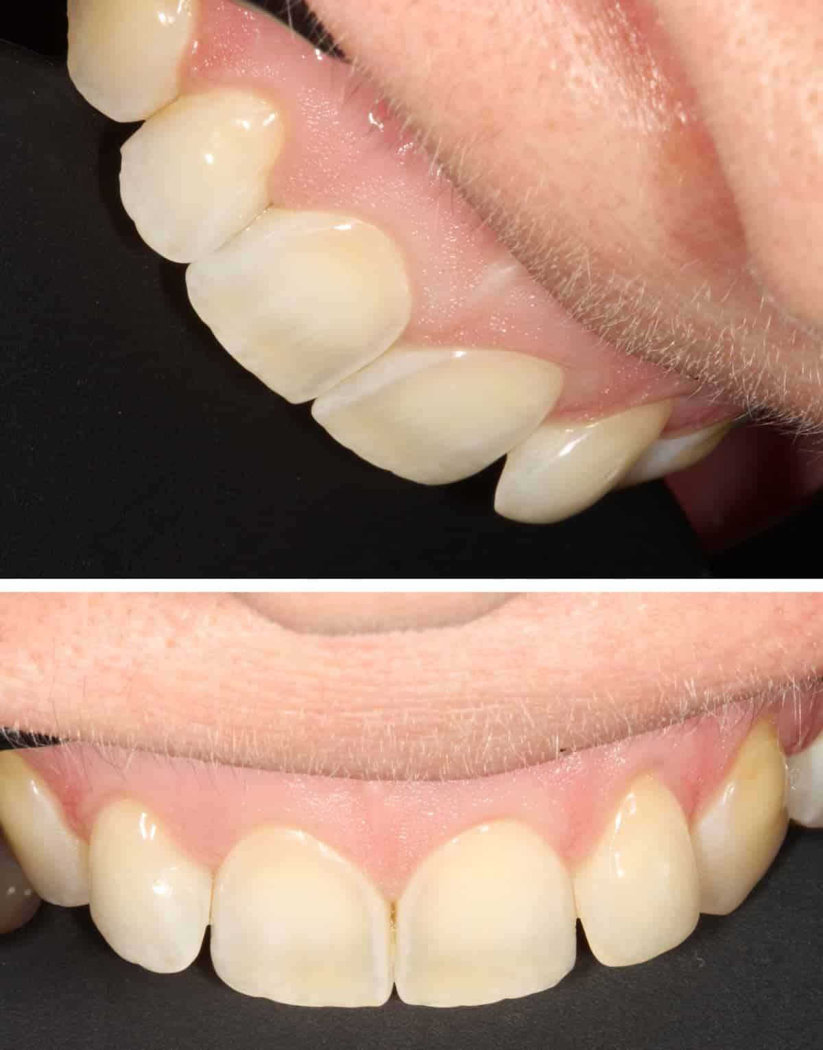 Nahaufnahme stark abgenutzter, verkürzter Frontzähne mit sichtbar abgeriebenem Zahnschmelz – typisches Schadbild durch abrasive Whitening-Produkte.