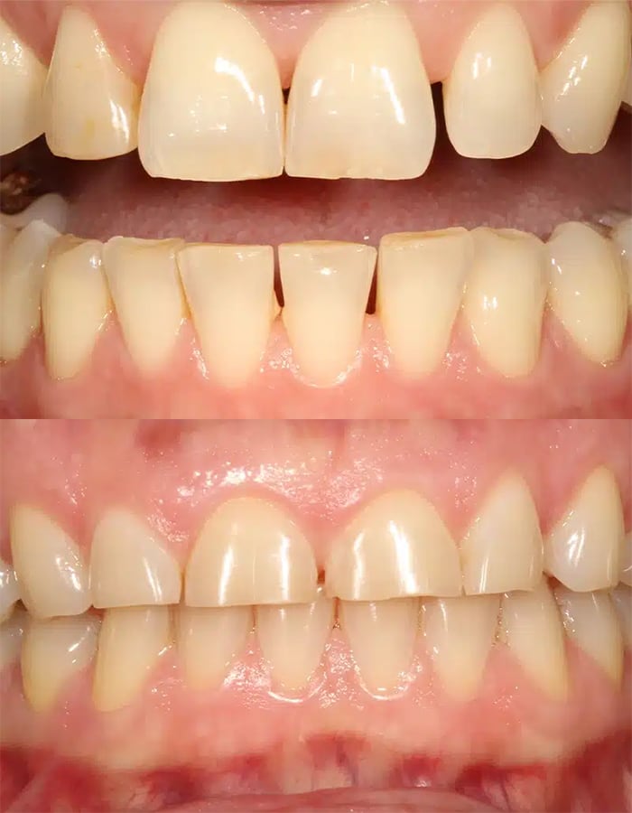 Zahnverschleiß, leicht/moderat